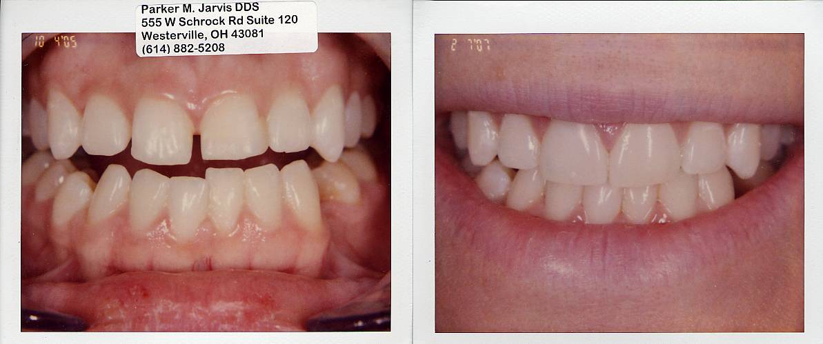 Veneers